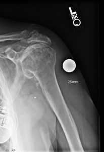 An x-ray of before a reverse shoulder replacement.