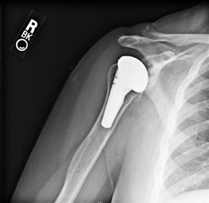 An x-ray of an after total shoulder replacement 