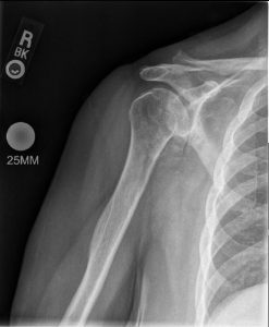 An x-ray of a total shoulder replacement before operation