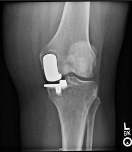 An x-ray of after a partial knee replacement 