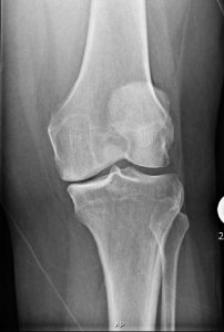 An x-ray of before a partial knee replacement 