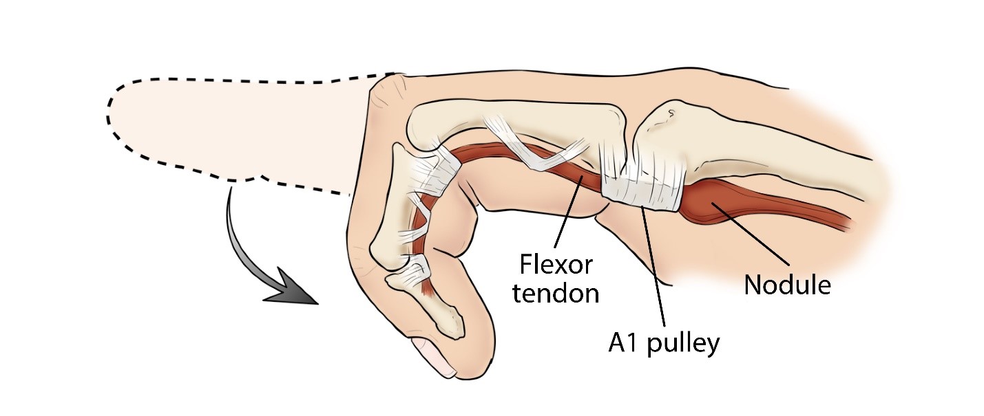 Trigger Finger Jared Lee MD