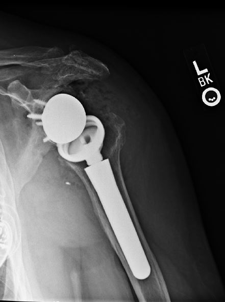 An x-ray of a reverse shoulder after the replacement.