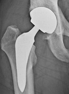 An x-ray of an after total hip replacement