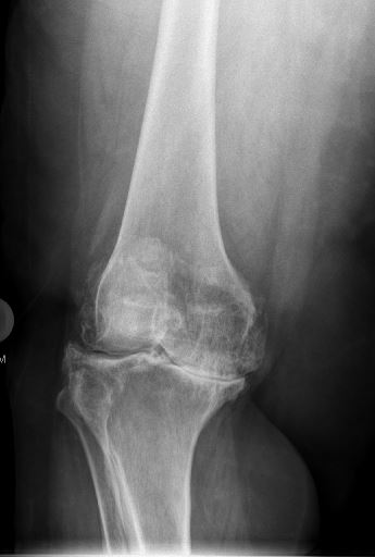 An x-ray of a total knee replacement before surgery