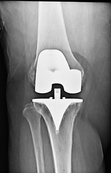 An x-ray of after an after total knee replacement