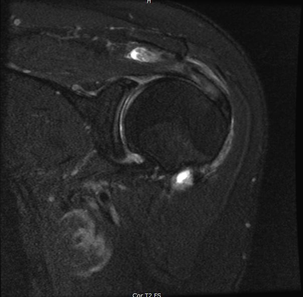 An x-ray of a rotator cuff tear