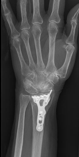 An x-ray of an after distal radius surgery