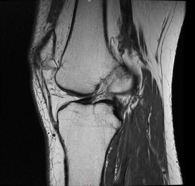 An x-ray of an ACL tear