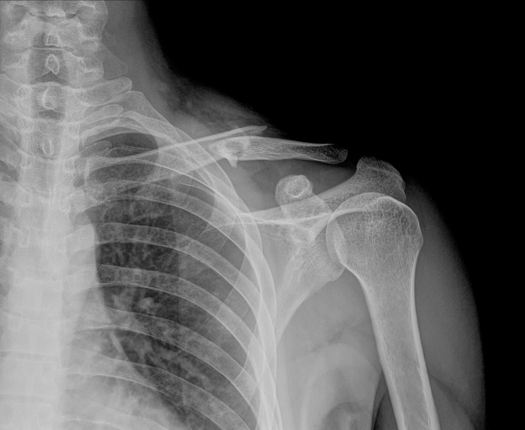 Clavicle Fractures - Jared Lee, MD