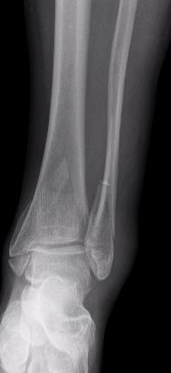 X-ray of an ankle fracture before