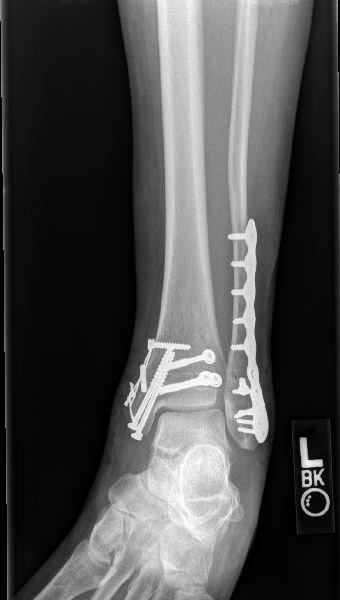 An x-ray of after an ankle fracture