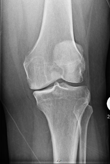 An x-ray of before a partial knee replacement
