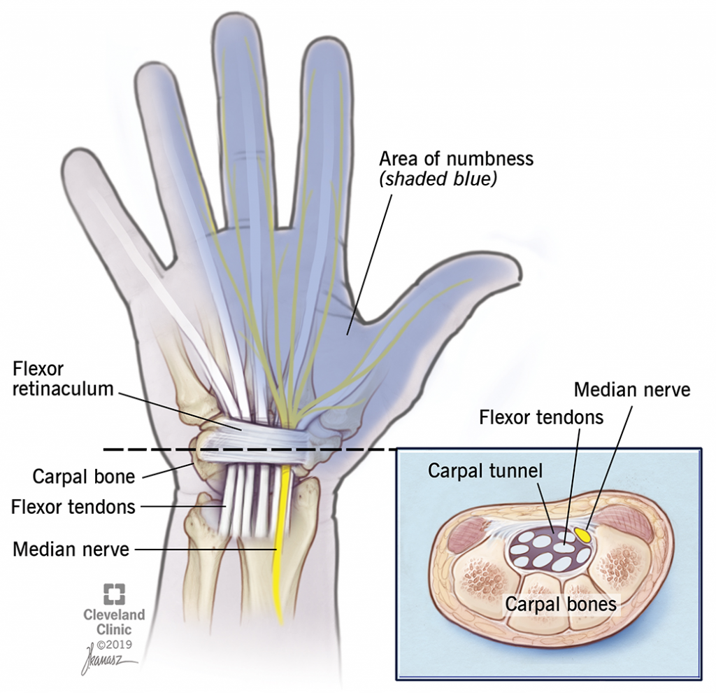 Carpal Tunnel Release - Jared Lee, MD