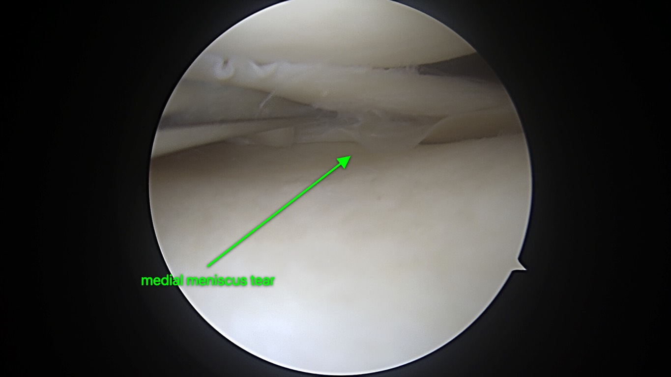 Meniscus Injuries - Jared Lee, MD