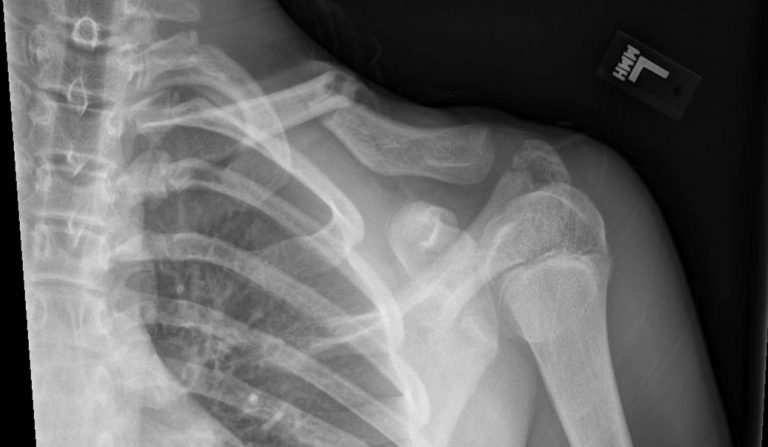 Clavicle Fractures - Jared Lee, MD