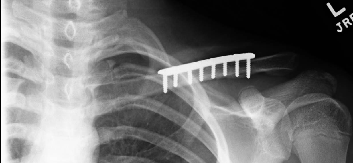 Clavicle Fractures - Jared Lee, MD